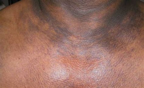 Dark Spots On Neck Chest Shoulder Causes And Cure Skincarederm