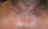 Red spots on the breast can suggest a series of conditions, including hives, rash or dermatitis. Dark Spots on Neck, Chest, Shoulder Causes and Cure ...