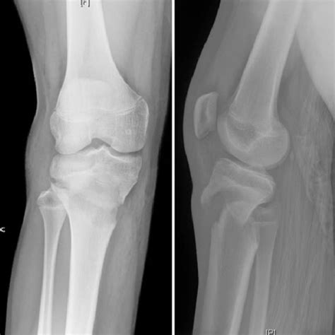 Ap And Lateral Radiographs After Attempted Closed Reduction Which