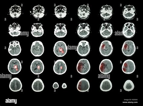 Hemorrhagic Stroke And Ischemic Stroke Ct Scan Of Brain