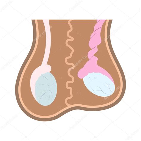 Illustration Of Normal Testicle And Testicle Torsion In Scrotum