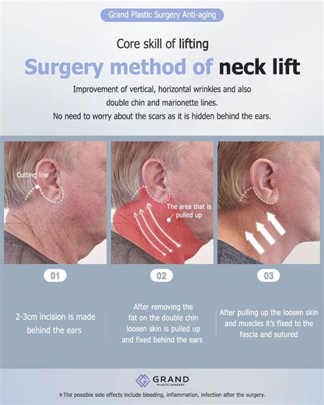 Surgery Method Of Neck Lift Neck Lift Saggy Skin Surgery
