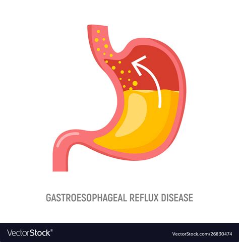 Gerd is a disorder where the contents of your stomach flow back into your esophagus. Gerd Icon - Nusagates