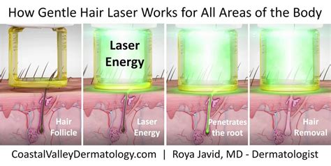 Laser Hair Removal Coastal Valley Dermatology