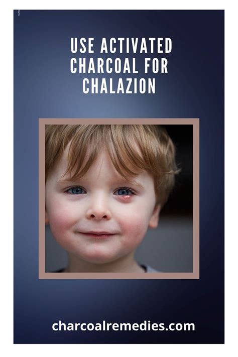 1 Natural Chalazion Treatment Charcoal Remedies