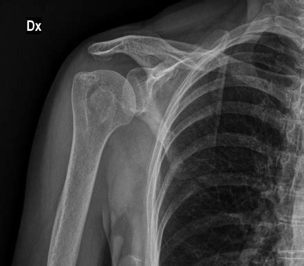 Humeral Lesser Tuberosity Avulsion Fractures Magnetic Resonance Hot Sex Picture
