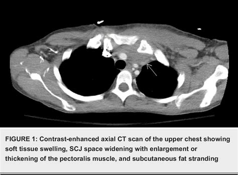 Figure From A Challenging Case Of Managing Septic Arthritis Of The Sternoclavicular Joint In A