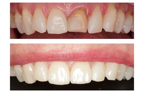 Tooth Recontouring Tooth Reshaping Brisbane Smile Boutique Dentists