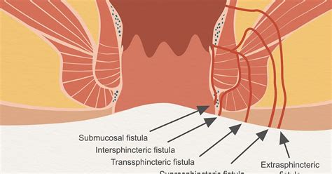 Fistula Ani Definisi Penyebab Gejala Diagnosis Komplikasi Pencegahan And Pengobatan