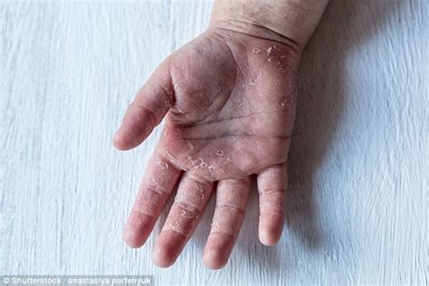 cases of victorian scarlet fever soar to highest levels in 60 years daily mail online