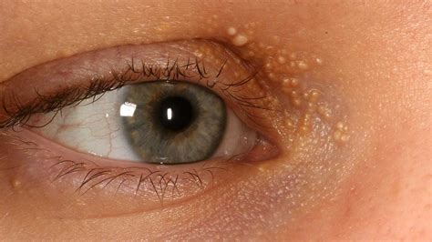 White Spots On Eyelids Pictures Picturemeta