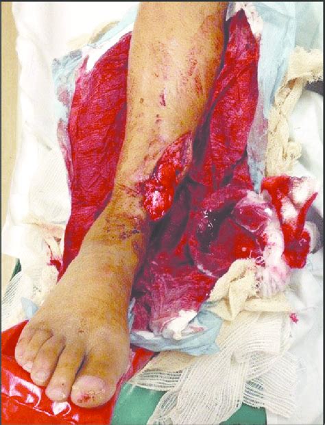 They will do an examination and order diagnostic tests to assess. Open fracture of the distal tibia | Download Scientific ...