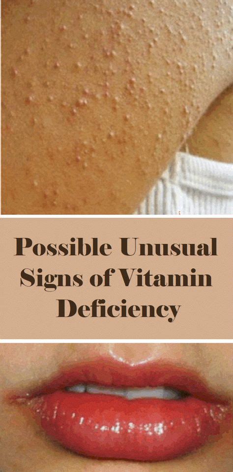 Pin By Sameer Dhaka On Lack Of Vitamin For Skin Vitamins For Skin