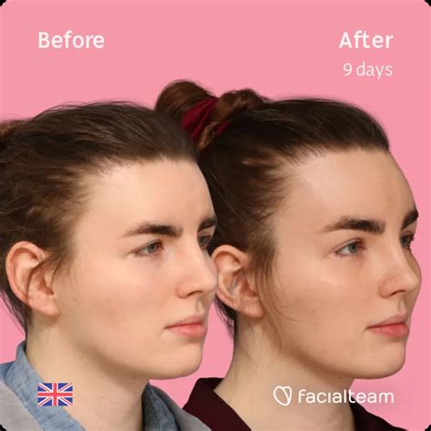 Eve Before And After Ffs Surgery — Facialteam