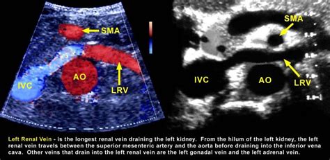 pancreas  left renal vein ultrasound google search medical