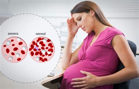 Cara Mengetahui Anemia Cara Mengatasi Anemia Dan Kenapa Ibu Hamil