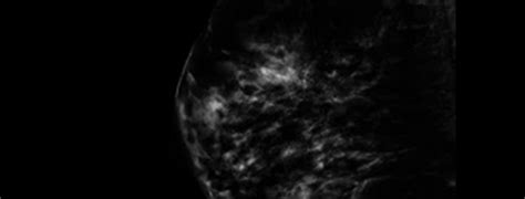 Digital Breast Tomosynthesis At Ascot Central Astra Radiology X Ray