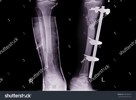 Xray Both Leg Show External Fixation Stock Photo Edit Now 493185070