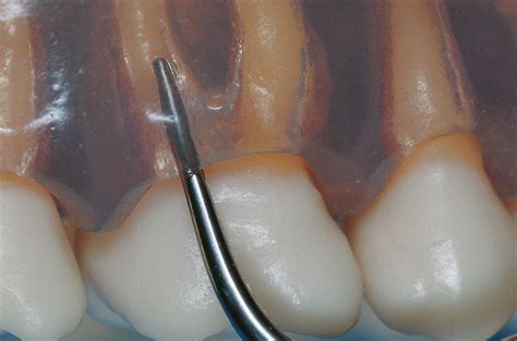 Sonicflex™ Tips A Suitable Tip For Any Indication Kavo Dental