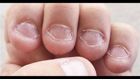 Bitten Nails Fixing And Nail Designs Which Will Suit You Youtube