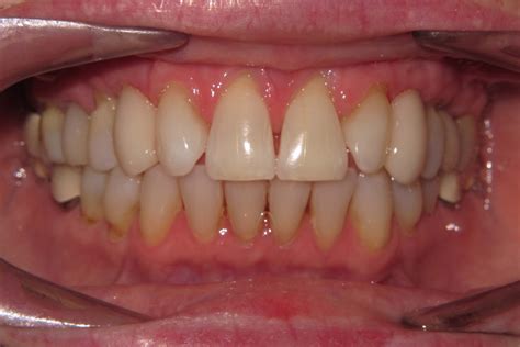 Implants Smile Gallery Raber Dental Kidron Dentist