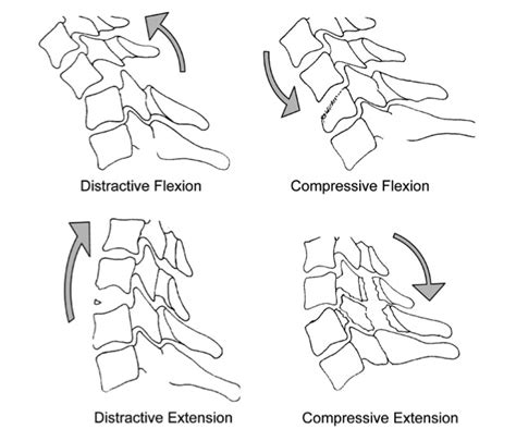 C Spine Injuries Ct Interpretation Core Em
