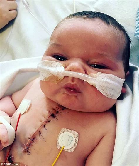 Baby Born With HALF A Heart Survives Surgery At 4 Days Old Goes Home At