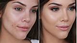 Pimple Cover Up Makeup