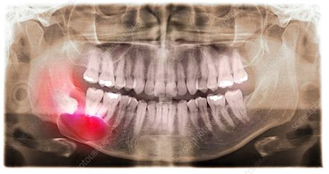 Impacted Wisdom Tooth Panoral X Ray Stock Image C0152822