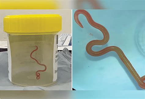 Unprecedented Discovery Parasitic Roundworm Found In Womans Brain