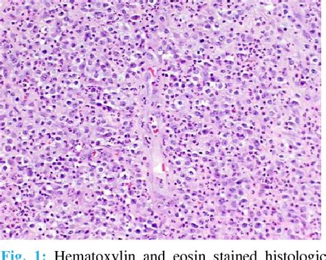 Figure 1 From Anaplastic Large Cell Lymphoma Associated With Breast