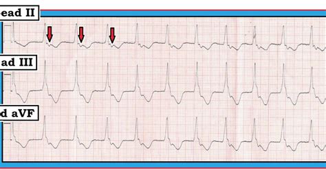 Ecg Interpretation Ecg Blog 108 Ventricular Rhythms Aivr Vt