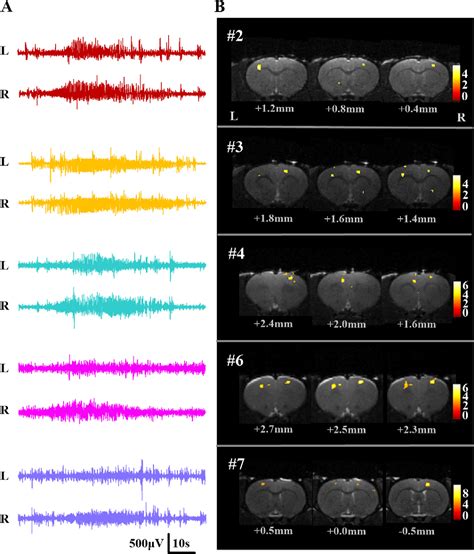 Figure 4 From Characterizing The Seizure Onset Zone And Epileptic