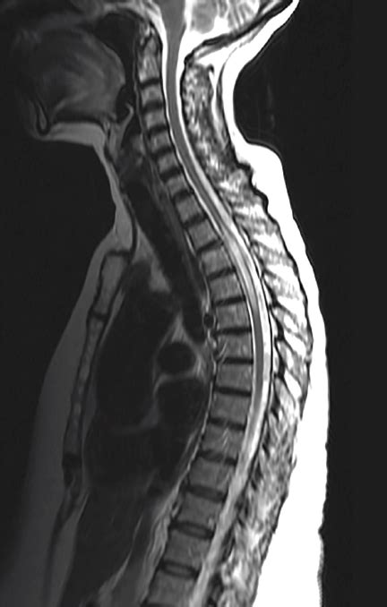 Therefore, physicians must be aware of the many potential etiologies for acute myelopathy, and should pursue. Case Report: Longitudinally Extensive Transverse Myelitis ...