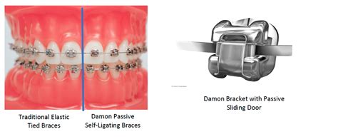 Sed Claire T Tulo Brackets Damon Colores Gusto Permiso Inducir