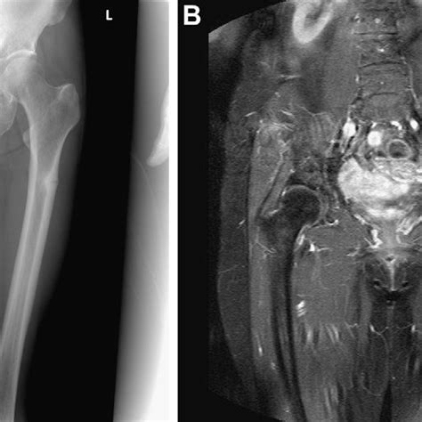 A Subtrochanteric Fracture Of The Left Femur With Intramedullary Nail