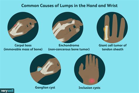 Lump On Wrist Or Hand Cysts Tumors And Other Causes