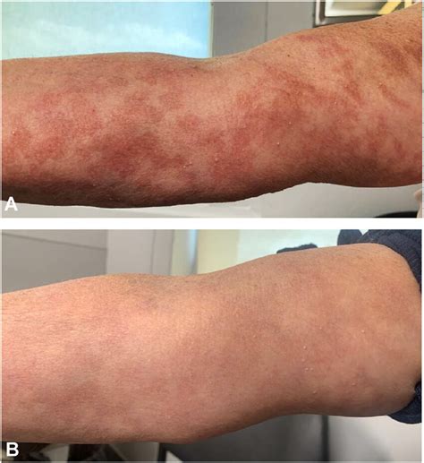 Bullous Pemphigoid Response To Upadacitinib A Right Arm 2 Months