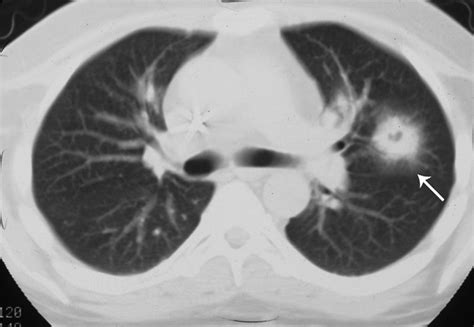 Ct Halo Sign Lungs