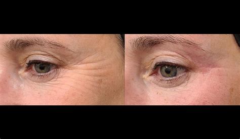 Radio Frequency For Dry Eye Treatment And Aesthetics In Chicago