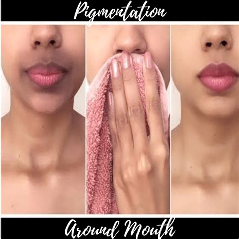 Causes And Remedies For Skin Pigmentation Around The Mouth Dark Skin
