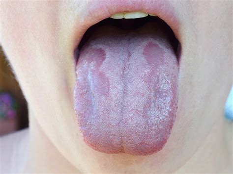 The Causes Of A White Tongue And How To Prevent It