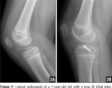 Figure 2 From Physeal Sparing Tibial Eminence Fracture Fixation With A