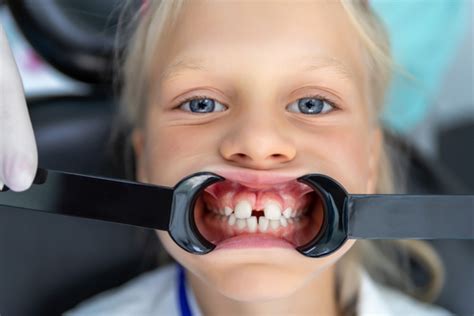 Braces For Kids Signs Your Child Needs Early Orthodontics Roberts