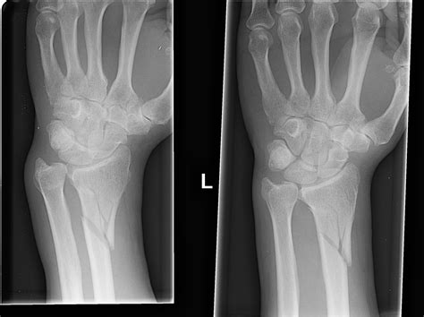 Galeazzi Fracture Dislocation Variant Image