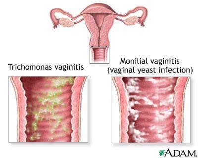 Causes Of Vaginal Itching MedlinePlus Medical Encyclopedia Image