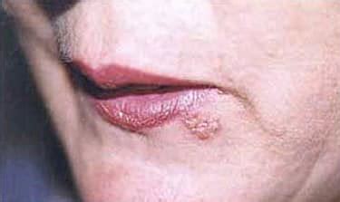 Herpes lablialis (cold sores) are caused by a virus that lies dorm. How to Dry Out a Cold Sore - Coldsorescured.com