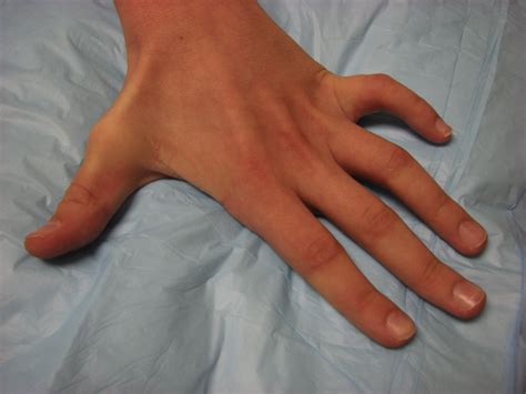 Ulnar Nerve Tendon Transfers For Pinch Hand Clinics