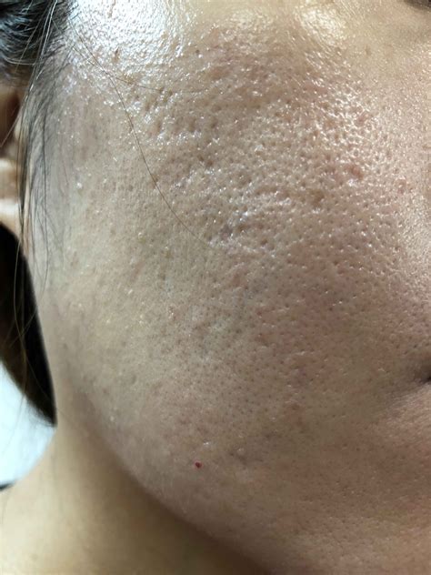 For Moderate Acne Scars How Do Doctors Determine How Much Improvement