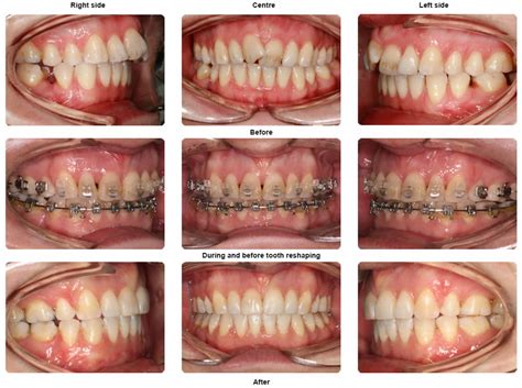 Braces Before And After Photo Gallery Orthodontics